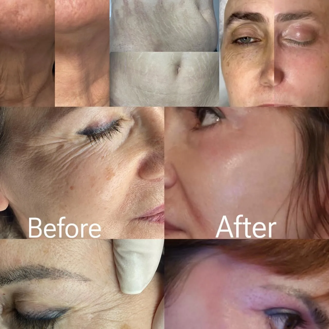 Plasma Phi-Ion Before & After αποτελέσματα